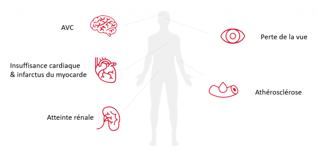 Conséquences de l'hypertension sur les organes